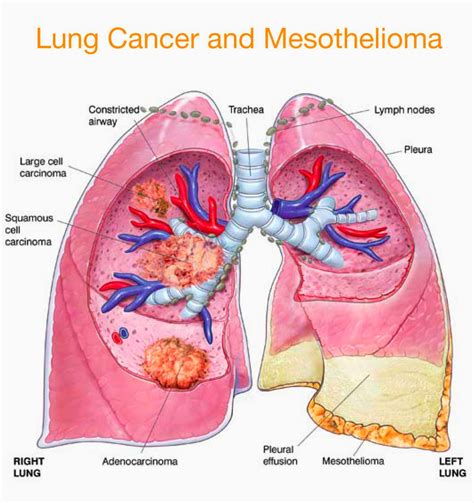 Cancer Treatment: Pleural mesothelioma: symptoms