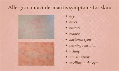 How to Treat Inflamed Skin and Contact Dermatitis - Skin Beauty