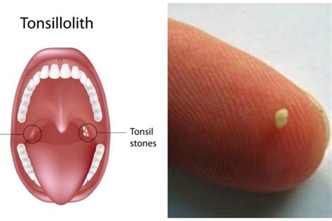 Early Tonsil Stones ~ Tonsil Stones Removal Tips