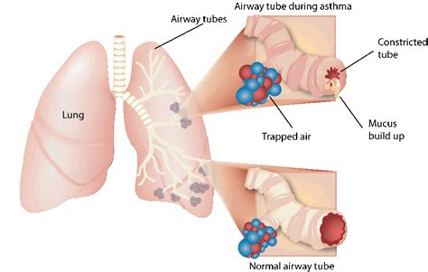 Asthma