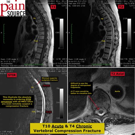 Vertebral Compression Fracture - MRI Images - The Pain Source - Makes ...