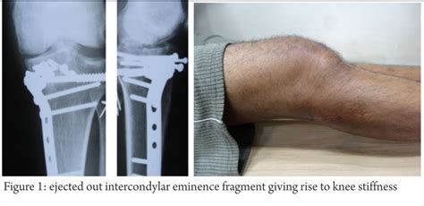 Tibia eminence fracture Archives - Trauma International