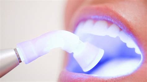 Is Laser Teeth Whitening an Option for You? | Colgate® SG