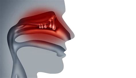 Nasal Polyps - OC ENT Clinic | Sinus Surgery | Septoplasty ...