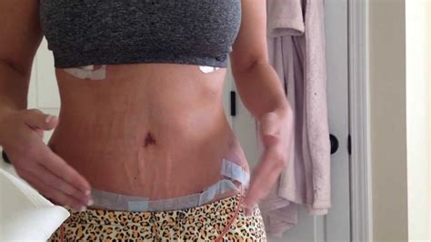 Tummy tuck recovery timeline - inputawesome