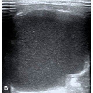 TIRADS category with risk malignancy. | Download Scientific Diagram