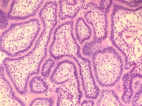 Plexiform Ameloblastoma Histology