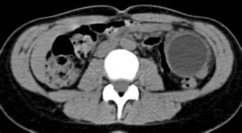 Mesenteric cyst: a rare cause of abdominal pain | Eurorad