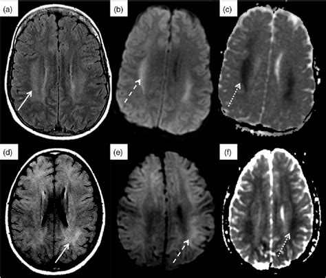 Head MRI findings in two patients with DDS. Patients 1 (a-c) and 2 (d-f ...