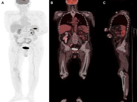 PET-CT of leukemic-lymphomatous muscle ınfiltration