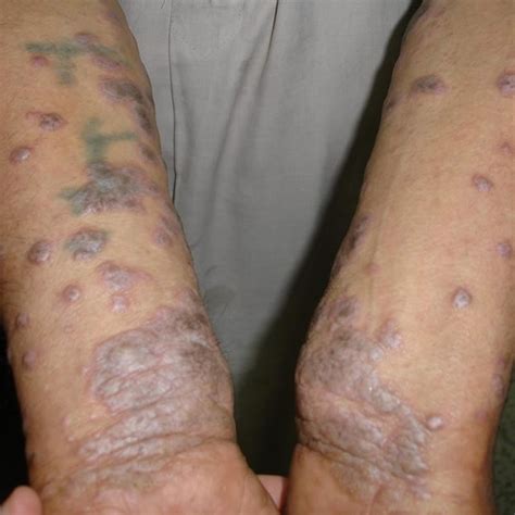 Lichen Planus: Causes, Symptoms, and Treatments | Dr. Health Clinic