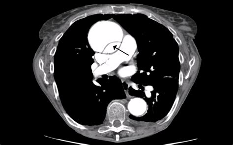 HD - Ultrasound of Aortic Dissection | EM:RAP