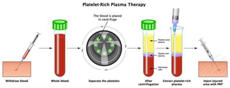 Platelet Rich Plasma (PRP) anti-aging knee arthritis therapy (Regenerative therapy) - Arthritis ...