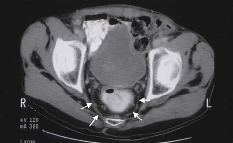 4: An axial CT scan at the level of the superior margin of the femoral... | Download Scientific ...