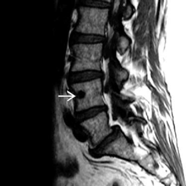 Bone Island | Radiology Key