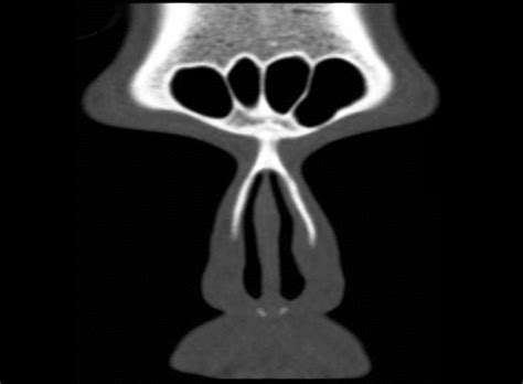 CT scan of paranasal sinus — coronal view showing normal frontal sinus ...