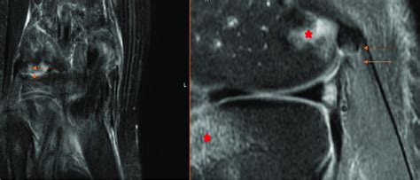 Magnetic resonance image of the fabella fracture (arrows) and tibial... | Download Scientific ...