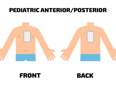 AED Pad Placement | Heartsmart