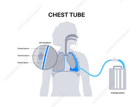 Chest tube catheter, illustration - Stock Image - F041/5934 - Science Photo Library