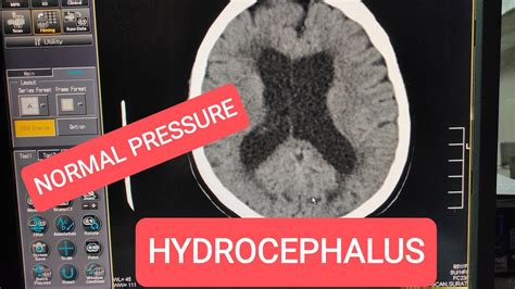 Normal Pressure Hydrocephalus CT Scan Brain. - YouTube