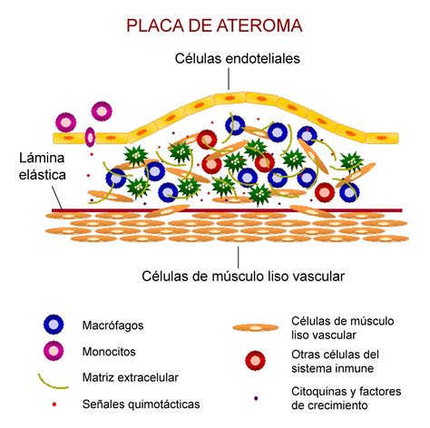 placa de ateroma - wood scribd braxin