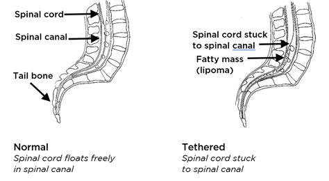 Tethered Spinal Cord - Seattle Children's