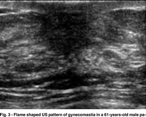 Male Gynecomastia Ultrasound