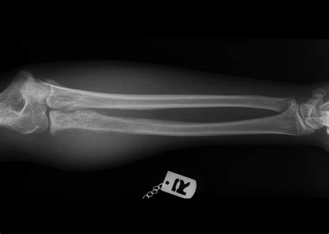 Osteosarcoma Sunburst