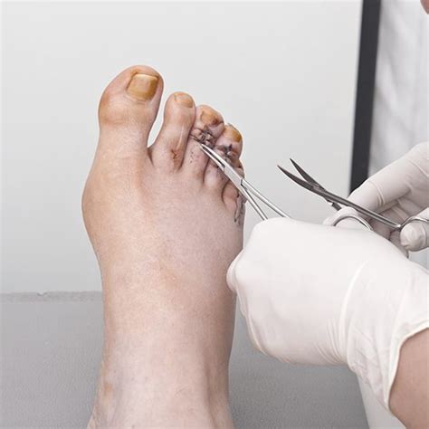 Hammertoe Surgery Specialist | Foot Doctor | Jaws Podiatry