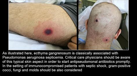 Ecthyma gangrenosum bei Pseudomonas aeruginosa Sepsis - YouTube