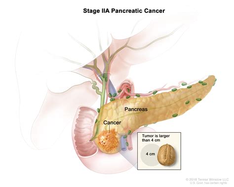 How Bad Is Pancreatic Cancer Stage 4 - CancerWalls