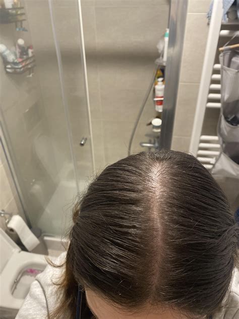 Rogaine appreciation post : r/FemaleHairLoss