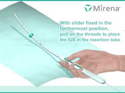 Mirena IUS insertion procedure (animated) - YouTube