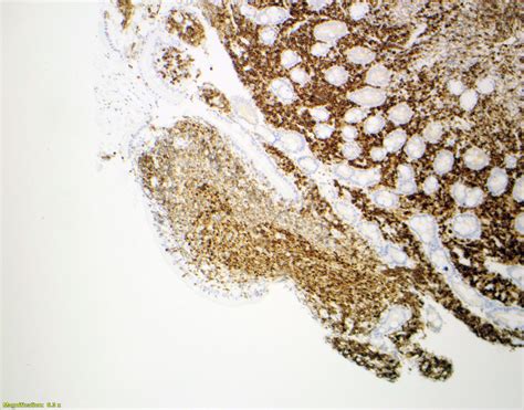 Follicular Lymphoma Pathology Outlines