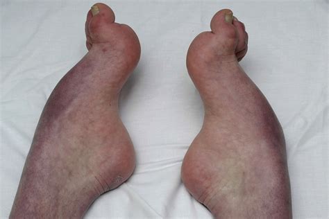 Assessment and management of cavus foot deformity - Orthopaedics and Trauma