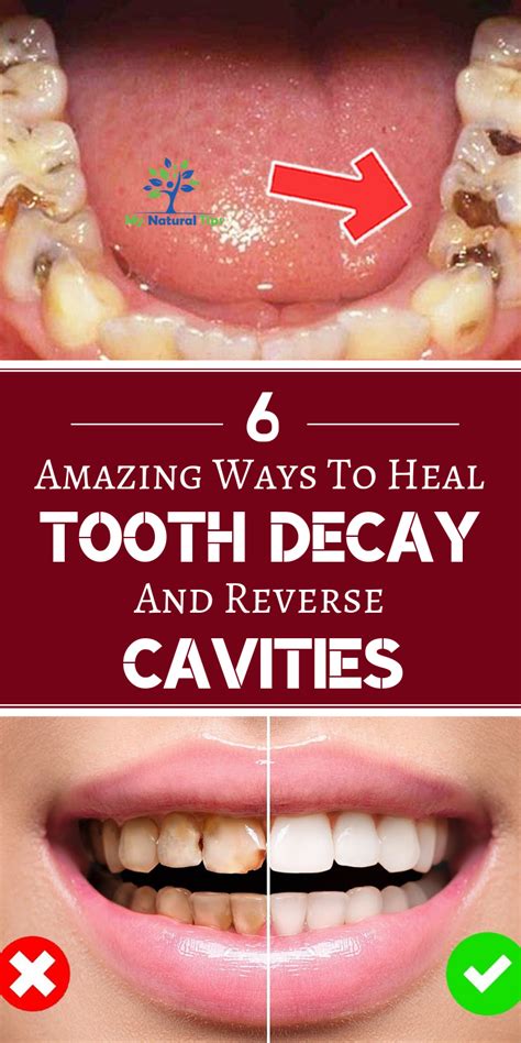 How To Heal Tooth Decay And Reverse Cavities – Naturally! | Tooth decay remedies, Heal cavities ...