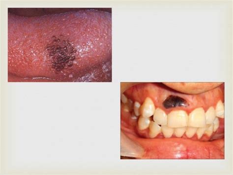 Tumor of oral cavity