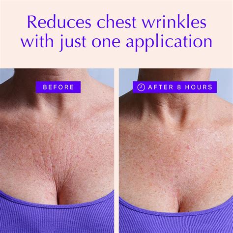 Chest Wrinkles At 25 | ubicaciondepersonas.cdmx.gob.mx