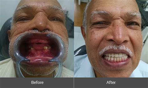 Dentures in Pune, Partial & Complete Dentures, Implant Supported Dentures