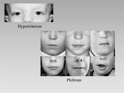 What is Aarskog-Scott Syndrome? - PT Master Guide