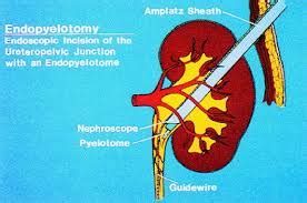 Endopyelotomy | Aafiya International