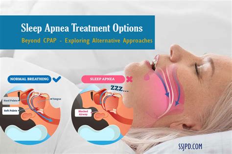 Sleep Apnea Treatment Options: Beyond CPAP - Exploring Alternative ...