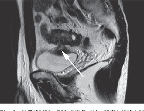 Figure 3 from A CASE OF SIGMOID COLON DIVERTICULITIS WITH A VESICOSIGMOIDAL FISTULA TREATED BY ...