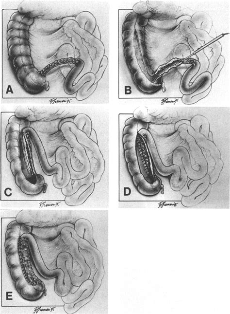 Terminal Ileum Cecum