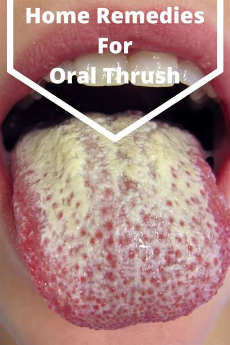 Top 12 Home Remedies for Oral Thrush - How to Get Rid of Oral Thrush?