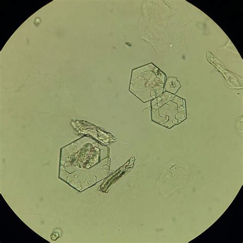 Cystine crystals #cystinecrystals #urinarysediment #cystinuria #medicallaboratory Microbiology ...