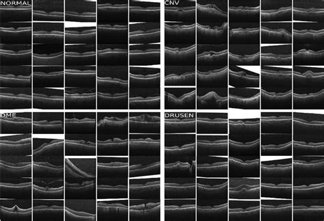 Sample OCT scans of eye diseases | Download Scientific Diagram