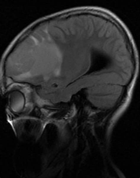 Ependymoma - NeurologyNeeds.com