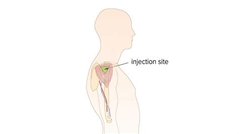 How To Administer An Intramuscular Injection In The Deltoid Muscle ...