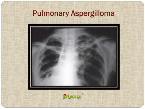 PPT - Pulmonary Aspergilloma: Causes, Symptoms, Daignosis, Prevention and Treatment PowerPoint ...